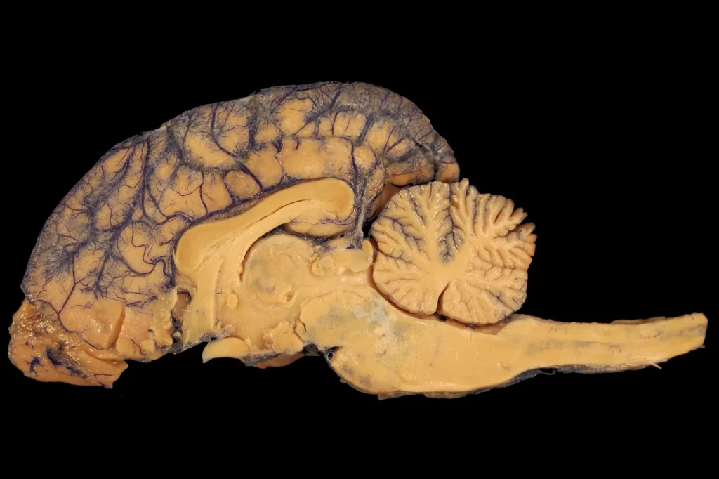 Dissection view of corpus collosum